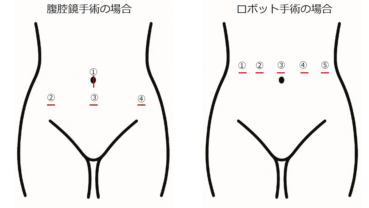 腹腔鏡手術、ロボット手術においては手術創の位置こそ違いますが、一つ一つの創が小さく、従来の大きな手術創とくらべて回復が早いことに変わりありません